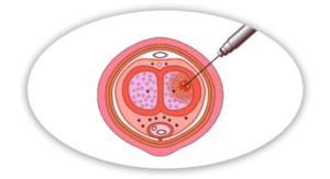 Penile Injections