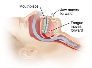 Insertion of a mouthpiece