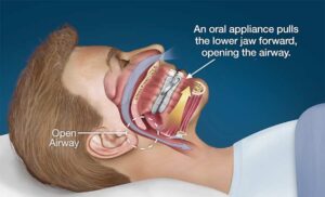 Surgeries to cure obstructive sleep apnea disorder