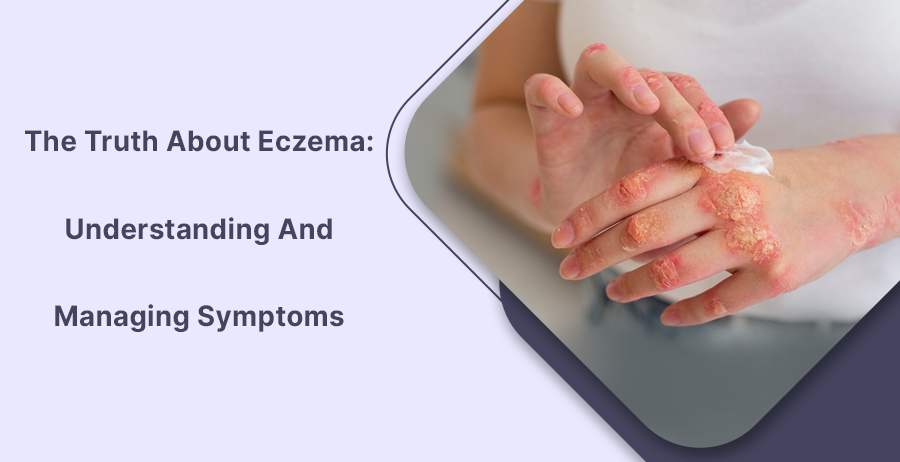 The Truth About Eczema Managing Symptoms