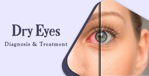 Dry Eyes Diagnosis And Treatment